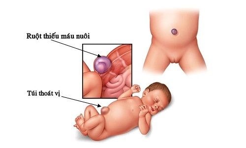 Dấu hiệu nhận biết tình trạng rốn lồi