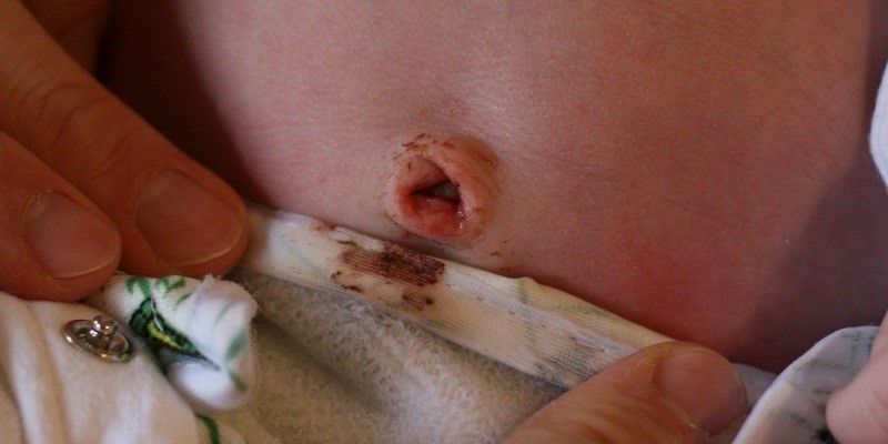 Hình ảnh rốn trẻ sơ sinh có mủ kèm máu