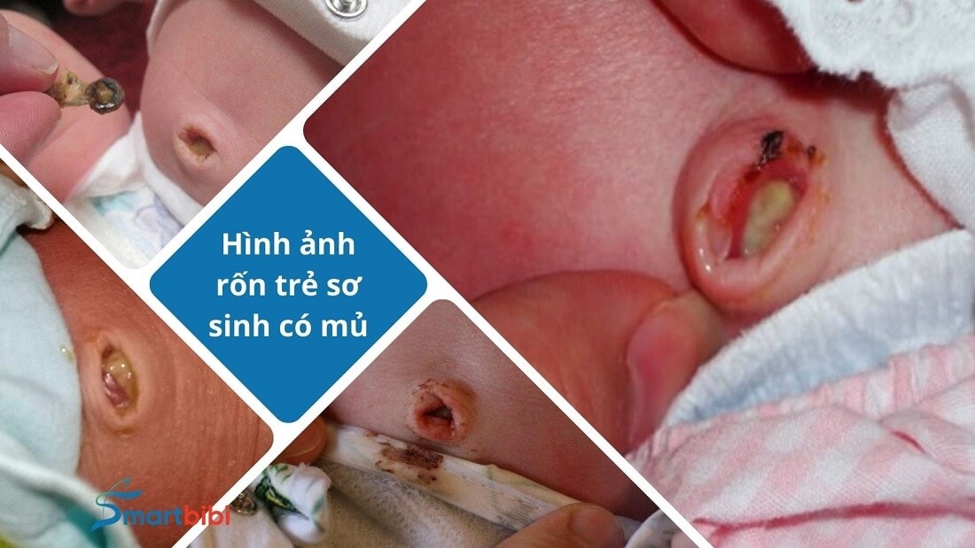 Hình ảnh rốn trẻ sơ sinh có mủ