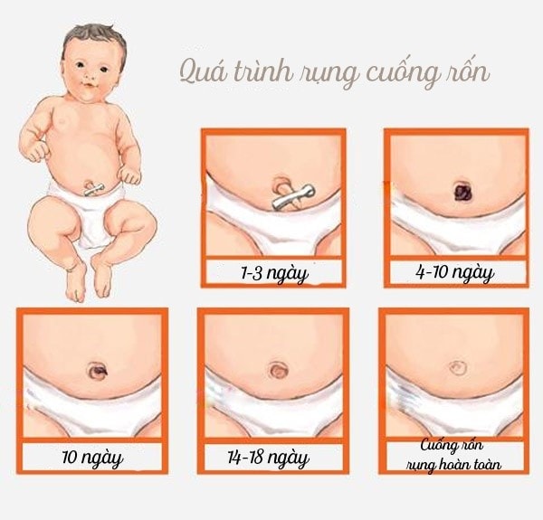 Quá trình rụng và trị khỏi rốn của con trẻ sơ sinh