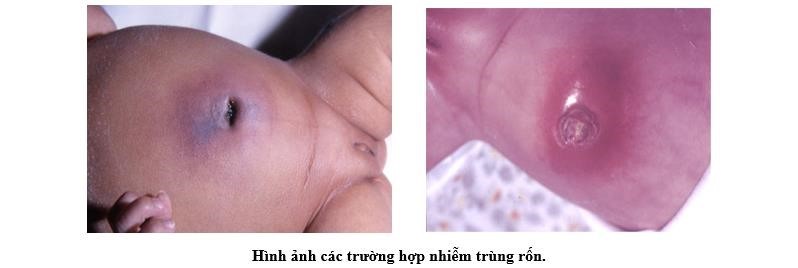 Rốn có mủ có thể cảnh báo tình trạng nhiễm trùng