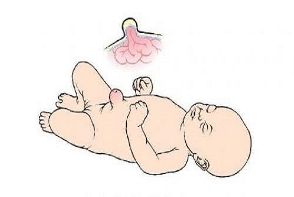 Hình ảnh rốn trẻ sơ sinh bị nhiễm trùng giúp mẹ dễ nhận biết