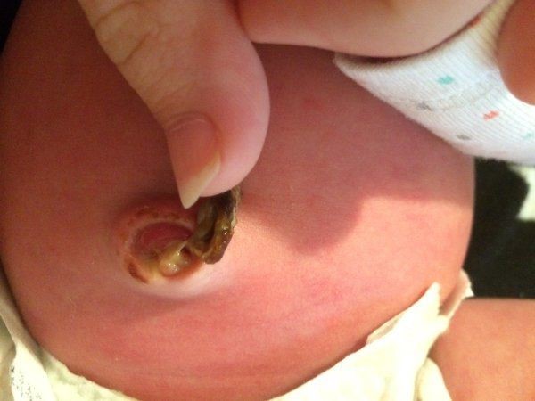Trẻ sơ sinh có mủ khi chưa rụng dây rốn