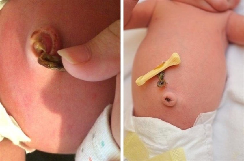 Trẻ sơ sinh có mủ ở rốn trước khi rụng