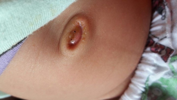 Trẻ sơ sinh có mủ sau khi rụng rốn