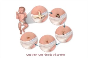 rốn trẻ sơ sinh bao lâu thì rụng