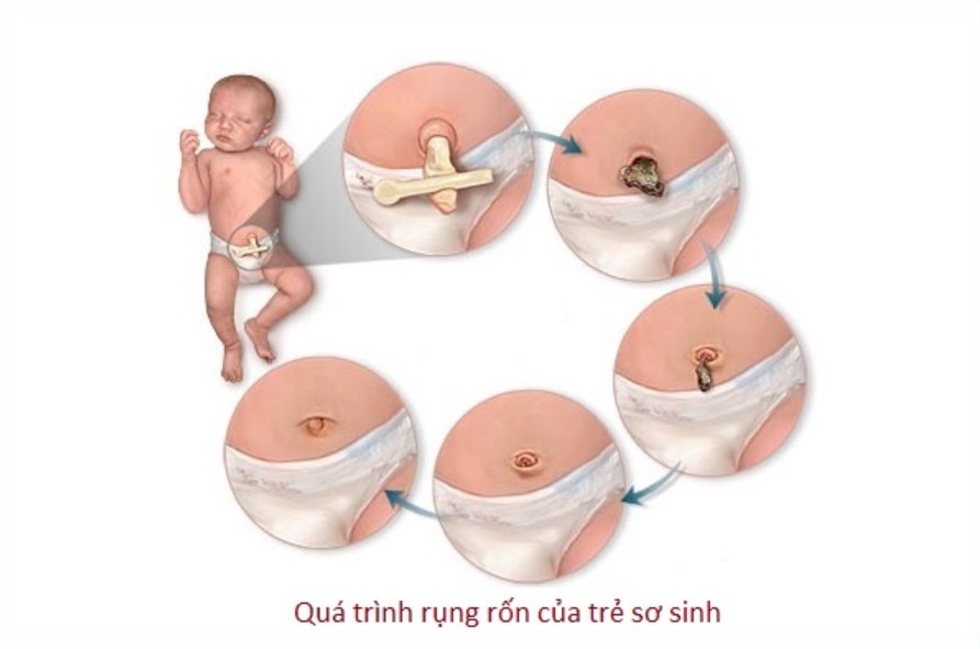 rốn trẻ sơ sinh bao lâu thì rụng