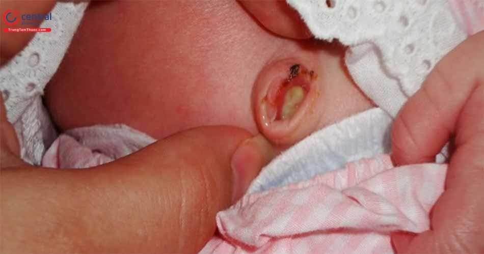 Hình ảnh nhiễm trùng rốn ở trẻ sơ sinh giai đoạn nặng