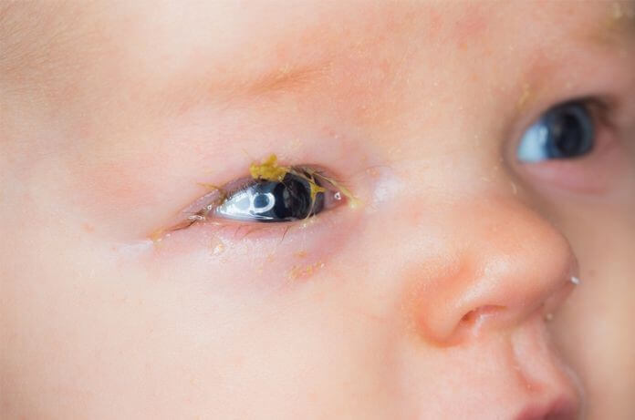 Mắt trẻ sơ sinh nhiều ghèn nên phải vệ sinh thường xuyên