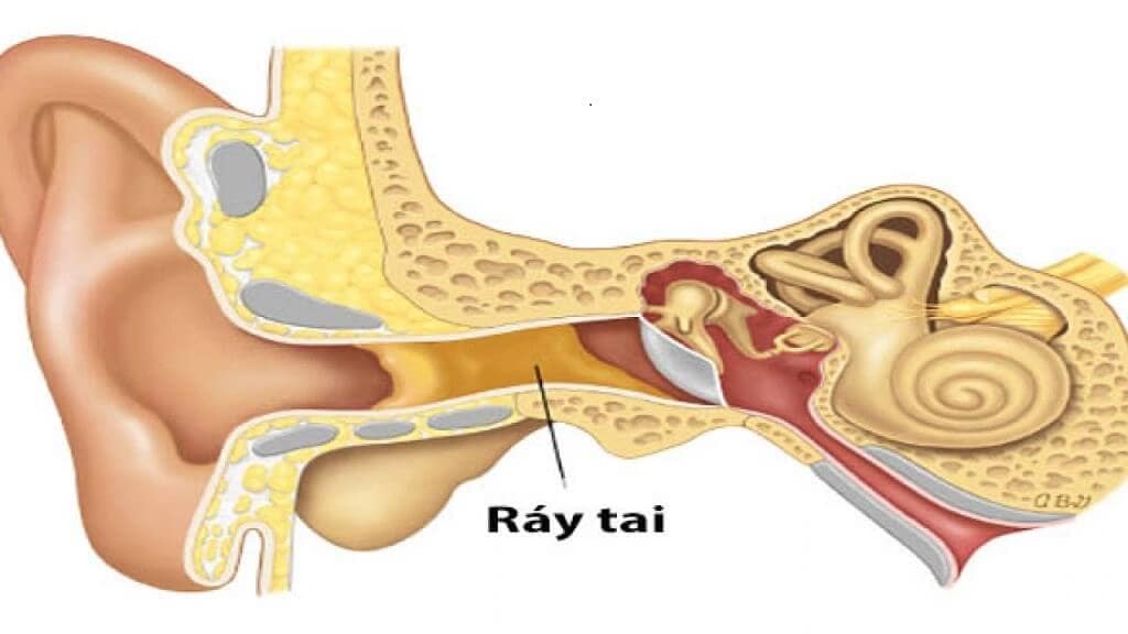 Ráy tai của trẻ có thể được làm sạch tự nhiên