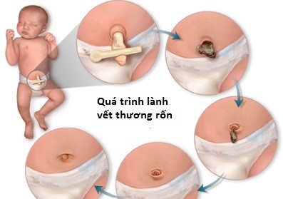 Quá trình lành rốn của trẻ sơ sinh