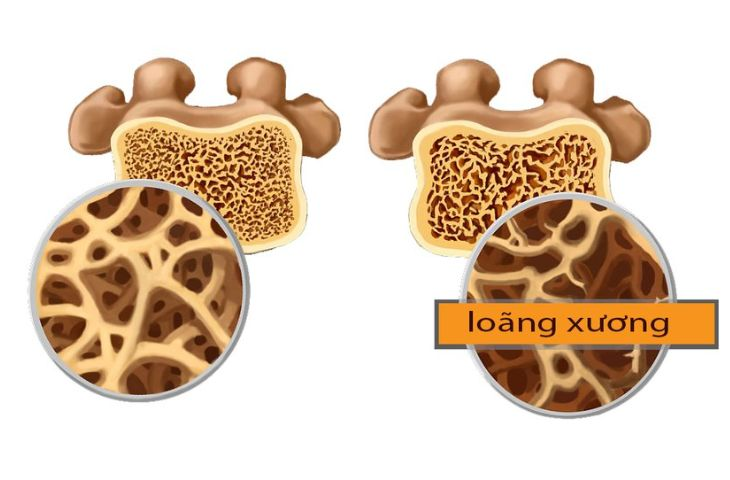 Loãng xương thường được ghi nhận ở những bé thừa D3