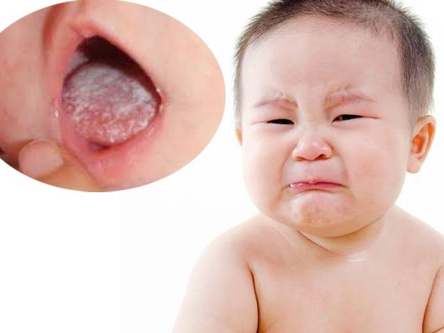 Nấm lưỡi ở trẻ sơ sinh