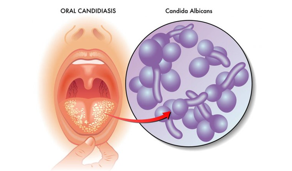 Nấm lưỡi chủ yếu là do nấm Candida gây ra