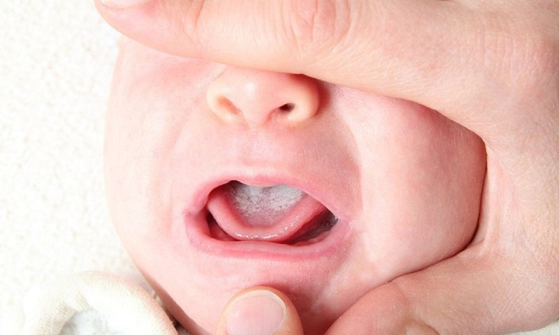 Trẻ sơ sinh thường quấy khóc khi bị nấm lưỡi
