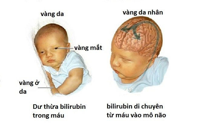 Biến chứng nguy hiểm trẻ có thể gặp khi bị vàng da