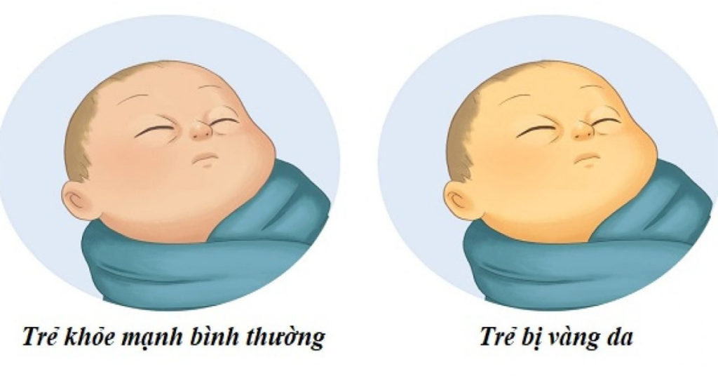 Dấu hiệu giúp mẹ nhận biết tình trạng vàng da