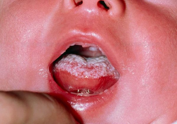 Nấm miệng khi đã lan rộng ra hết bề mặt của lưỡi