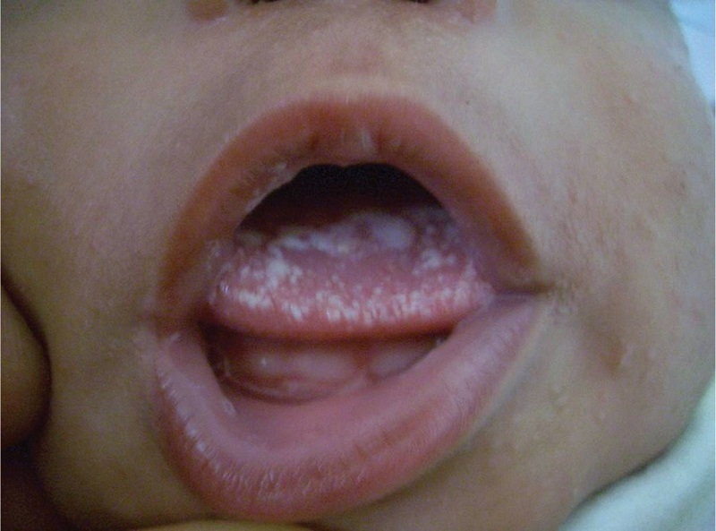 Nấm miệng gây nhiều đau đớn cho trẻ